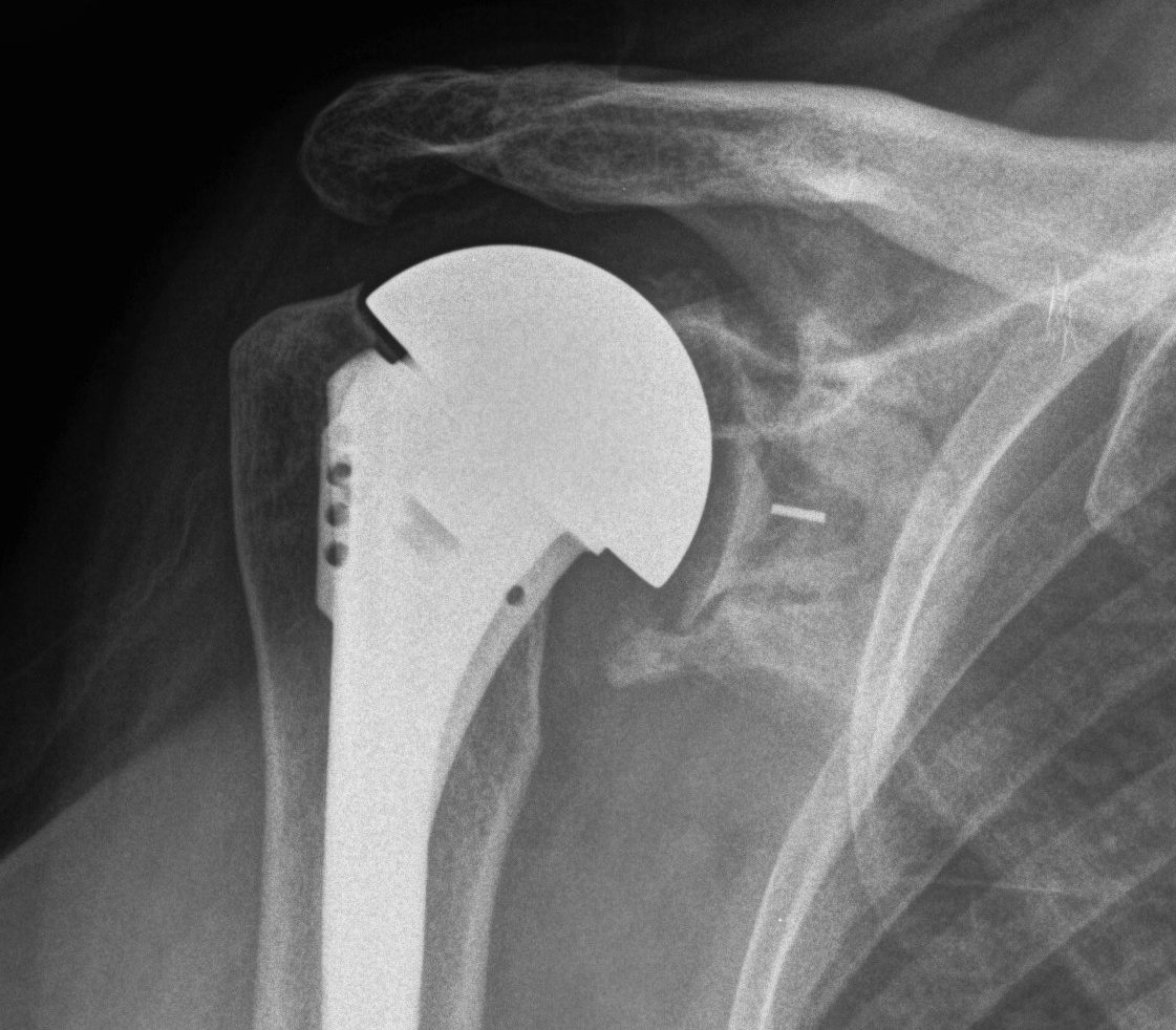 Glenoid Component Loosening